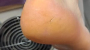 ТРЕЩИНЫ НА ПЯТКАХ как избавиться. Педикюр колпачками. Extremely Calloused Feet. 修腳, 腳趾甲, 修指甲