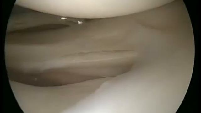 Горизонтальный разрыв заднего рога латерального мениска смотреть онлайн