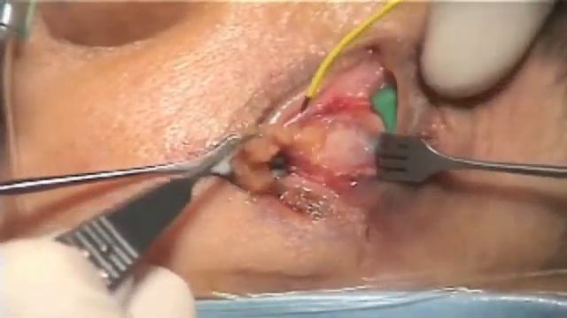 Трансконьюнктивальная блефаропластика Dr Reynaldo M Javate, Phiippines смотреть онлайн