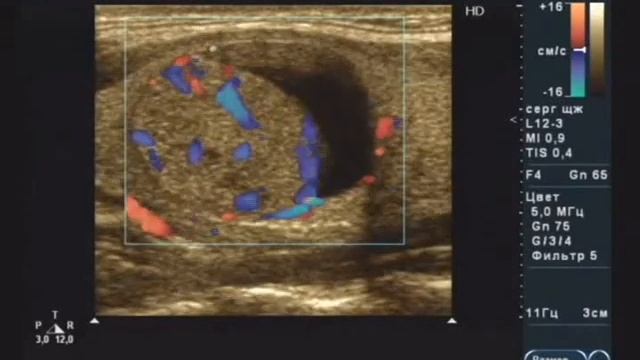Видеоанонс к лекции УЗД заболеваний щитовидной железы смотреть онлайн