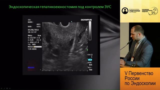 Первый опыт эндоскопического формирования пункционного гепатикоэнтероанастомоза смотреть онлайн