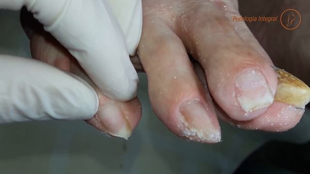 Onychomycosis, onychogryphosis and helomas (Part 1) #podologiaintegral смотреть онлайн
