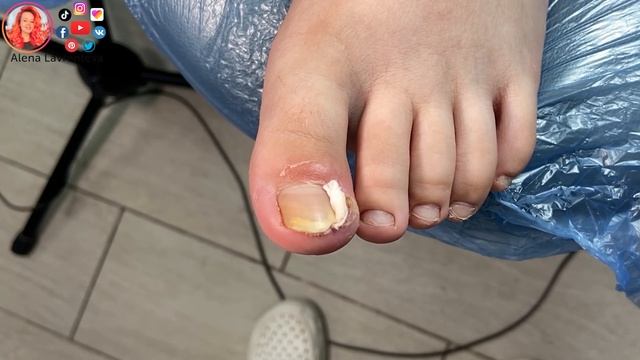 Вросший ноготь после травмы / Вросший ноготь у ребенка смотреть онлайн