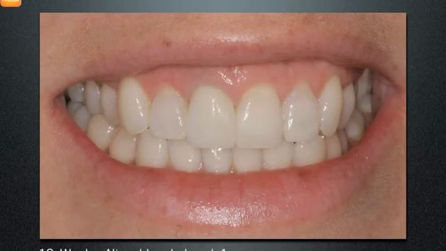 Inman Aligner provided by Comfort First Family Dental смотреть онлайн