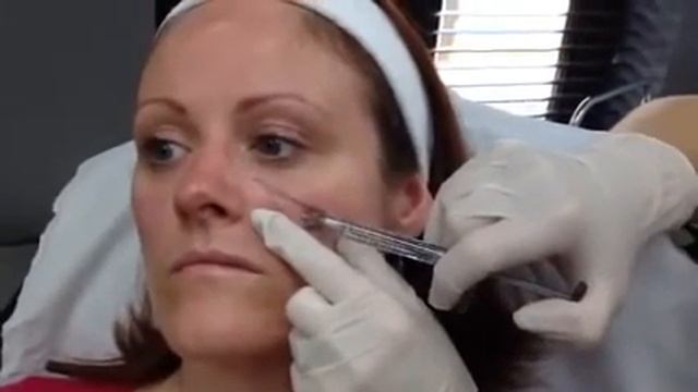 Angela - Volumising Juvederm Ultra4 and Voluma смотреть онлайн