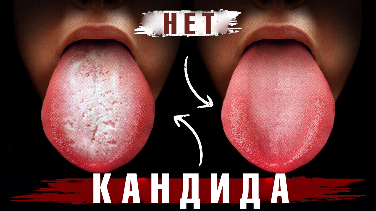 Начните делать это сейчас – и избавитесь от кандидоза навсегда!? смотреть онлайн