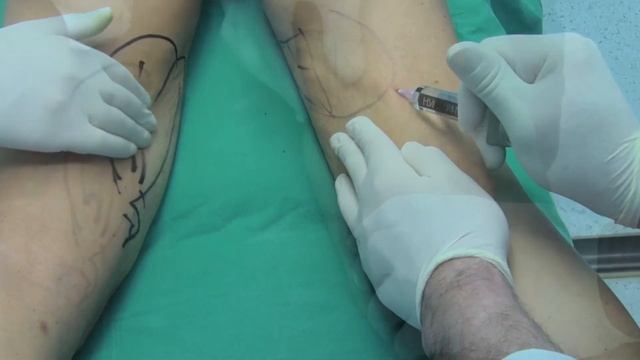 Контурная пластика ягодичной зоны смотреть онлайн