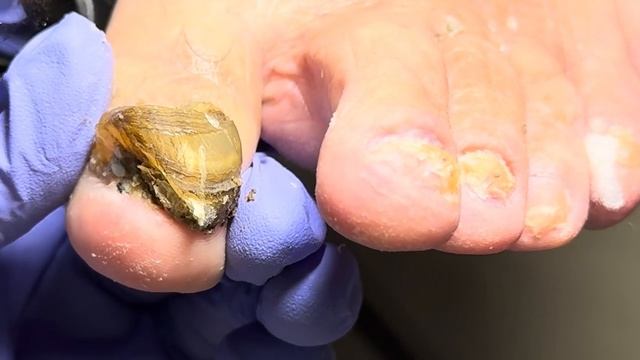 Wow ~ Super Onychomycosis, The Bacteria Has Infected All The Nails【Doctor Liu Pedicure】