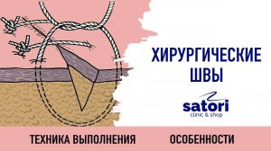 Хирургические швы в стоматологии