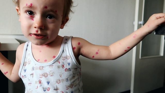 vlog не так уж страшна ветрянка смотреть онлайн