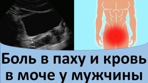Боль в паху и кровь в моче у мужчины.