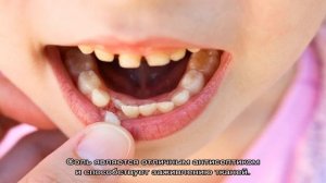 Как укрепить десна, если шатаются зубы при пародонтозе, гингивите, пародонтите? Шатается передний .