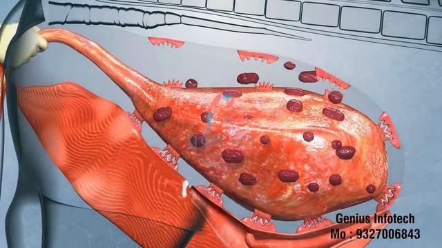 Retention of Placenta 3D Animation in Hindi made by Bluechisel смотреть онлайн