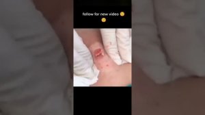 НОВОЕ ВИДЕО 2021  Прыщи давить залипательные