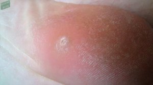 5 Способов Быстро Вытащить ЗАНОЗУ | ✅Как Вытащить ЗАНОЗУ Если Она Глубоко