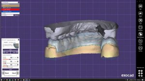 14. Моделирование сплинта или капа