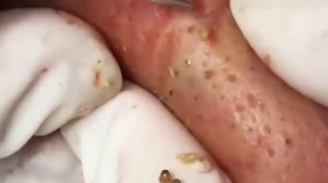 Professional bleckheads   Выдавливание черных точек прыщей   самое залипательное видео 2022