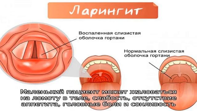Признаки ларингита у детей смотреть онлайн