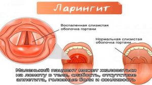 Признаки ларингита у детей