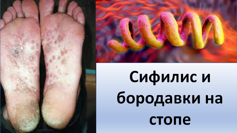 Сифилис и бородавки на стопе смотреть онлайн