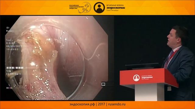 Эндоскопическое лечение дивертикула Ценкера. Что может быть нового? смотреть онлайн
