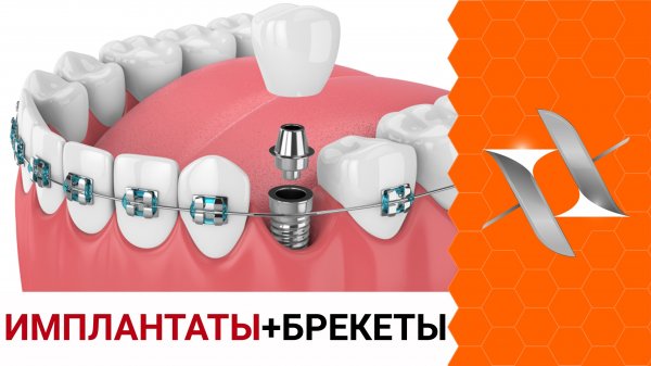 ИМПЛАНТАТЫ + БРЕКЕТЫ: 7 советов об имплантации. Взгляд ортодонта.