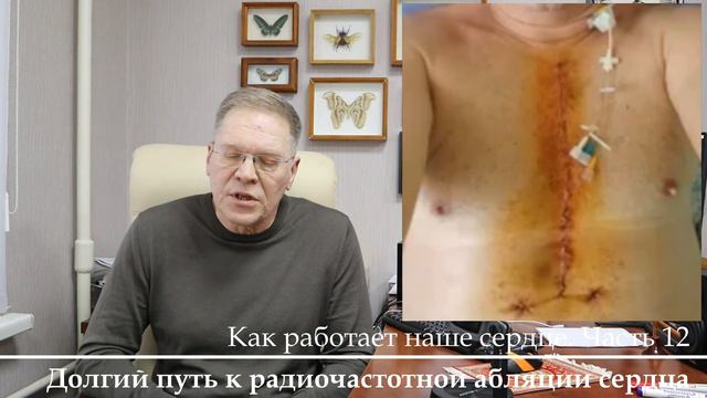 Как работает наше сердце. Часть 12. Долгий путь к радиочастотной абляции сердца (РЧА).