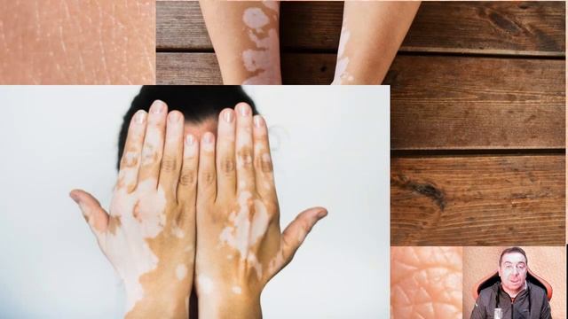Как я боролся с ВИТИЛИГО и что мне помогло? How did I deal with VITILIGO and what helped me? смотреть онлайн