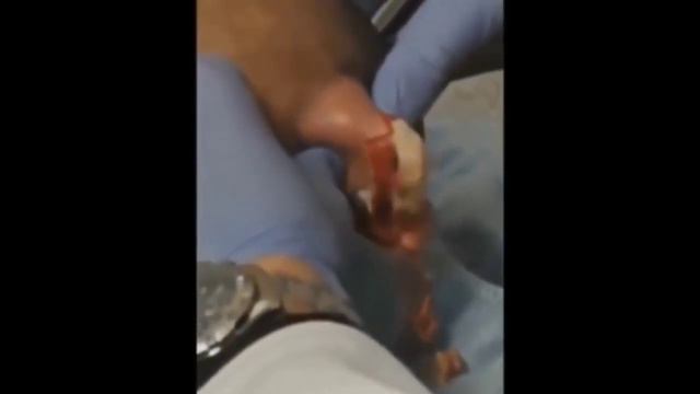 Прыщи давить залипательные НОВОЕ ВИДЕО 2021 смотреть онлайн