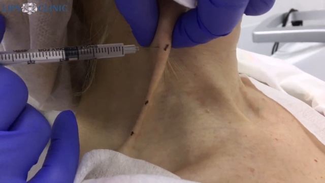 Ботокс и коррекция овала лица