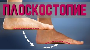 5 простых упражнений от Плоскостопия на каждый день!