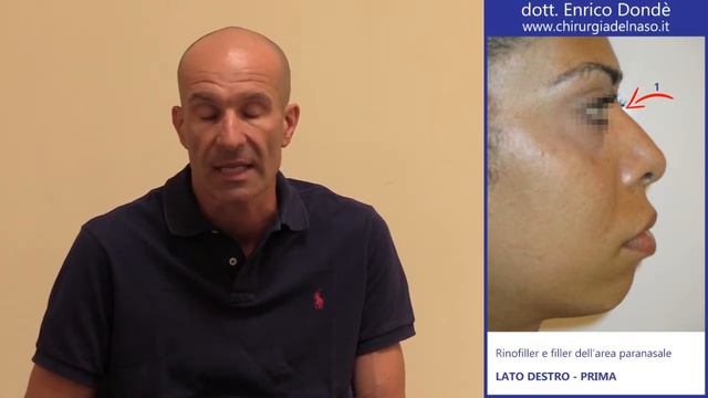 Rinofiller e filler dell'area paranasale | un caso etnico | Dr. Enrico Dondè смотреть онлайн