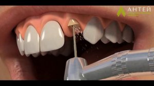 Коронка на штифте