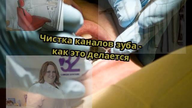 Чистка каналов зуба - как это делается