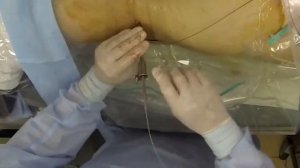 Видео 2 — / Миниперкутанная нефролитотрипсия /