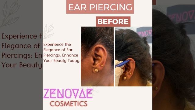 ZENOVAE - COSMETICS , A One Stop for Cosmetic Procedures [Permanent Lip Coloring, Ear Piercing] смотреть онлайн
