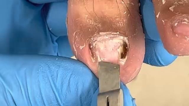 Removal Of Black Bad Nails, Ongoing Treatment...【Xue Yidao】