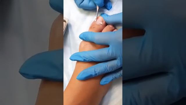 Установка BS пластины (лечение вросшего ногтя) - Эстетико-подологический центр Елены Басковой смотреть онлайн