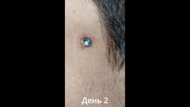 Удалил родинку на лице лазером. Мусин Михаил смотреть онлайн