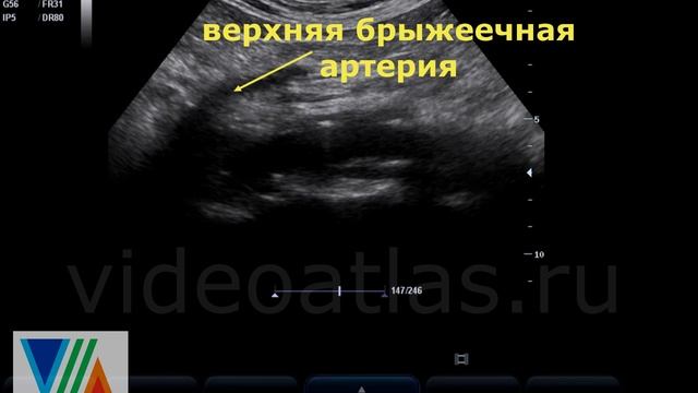 Склероз стенок Ао смотреть онлайн