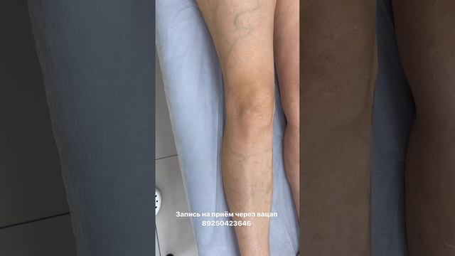 Лечение варикоза лазером. Результат. Узи сосудов. Узи вен. Сосудистый хирург. Флеболог Москва смотреть онлайн