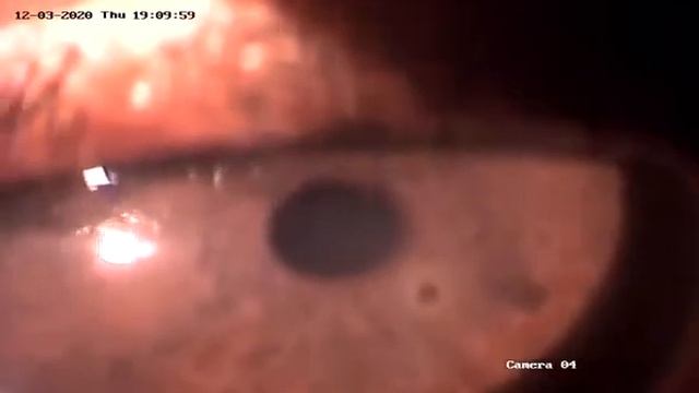 Foreign Body Removal by Algerbrush 360p смотреть онлайн