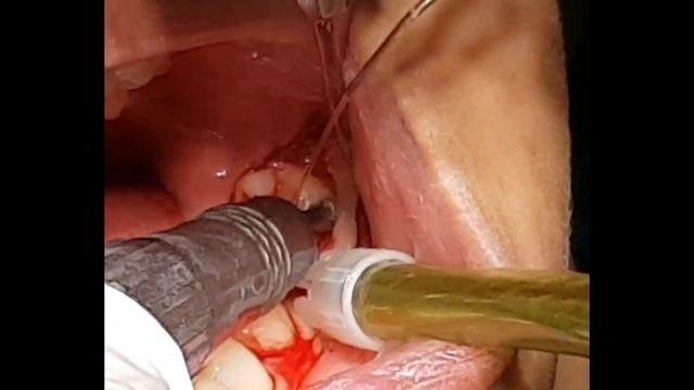 Wisdom Tooth Extraction (LL8)/wisdom tooth removal surgery video/3rd molar by Dr.Indraniil смотреть онлайн