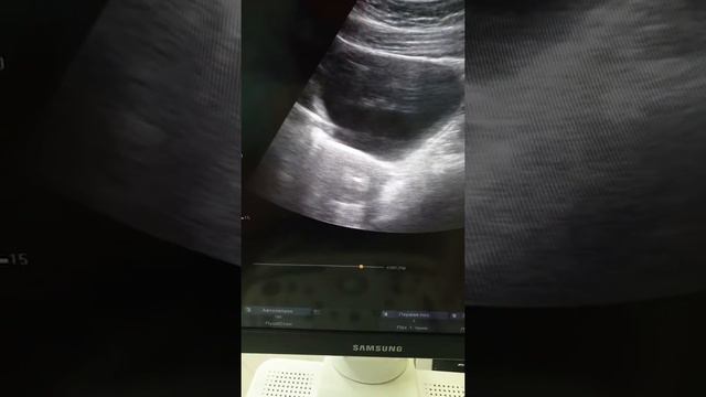 Рабочие будни. Перенос эмбрионов смотреть онлайн