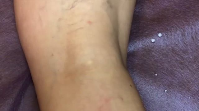 Склеротерапия телеангиоэктазий и ретикулярных вен. смотреть онлайн