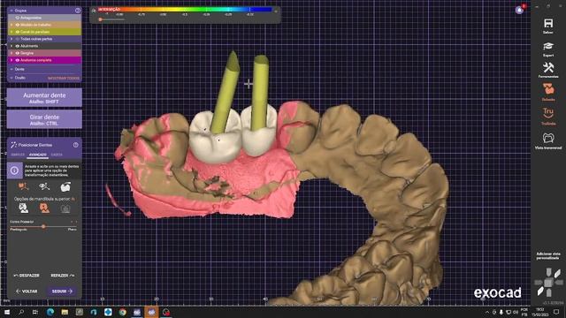 Exocad cad cam fazendo furo na coroa para implante sobre munhão personalizado смотреть онлайн