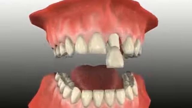 Отличие полностью керамической коронки от металлокерамической смотреть онлайн