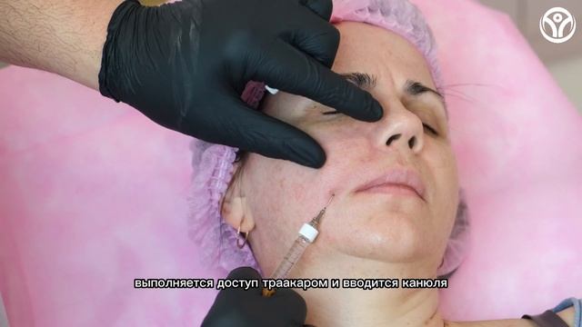 Коррекция носогубных складок филлером (А.А. Чопикян)
