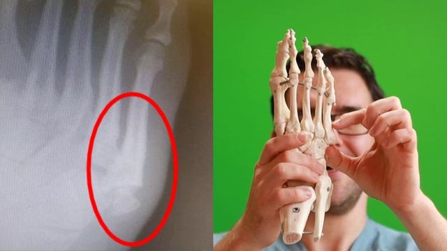 5th Metatarsal Jones Fracture [Recovery, Treatment & Surgery] 2022!