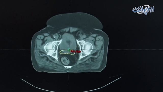 First Cancer Hospital Jahan Koi Cash Counter Nahi - Cancer Patients Ka Free Treatment Kese Hota Hai смотреть онлайн